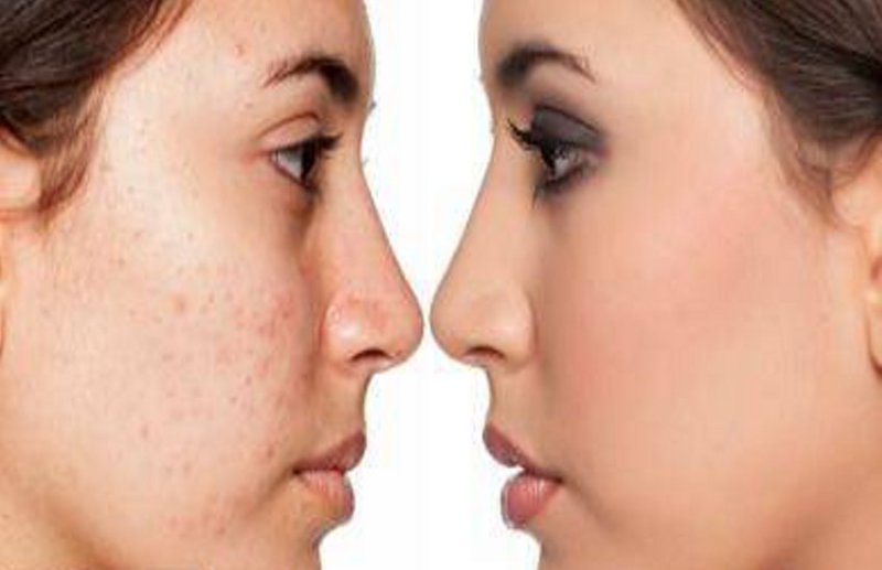 फुंसी-पिंपल्स से बचना है तो बारिश में इनसे करें परहेज