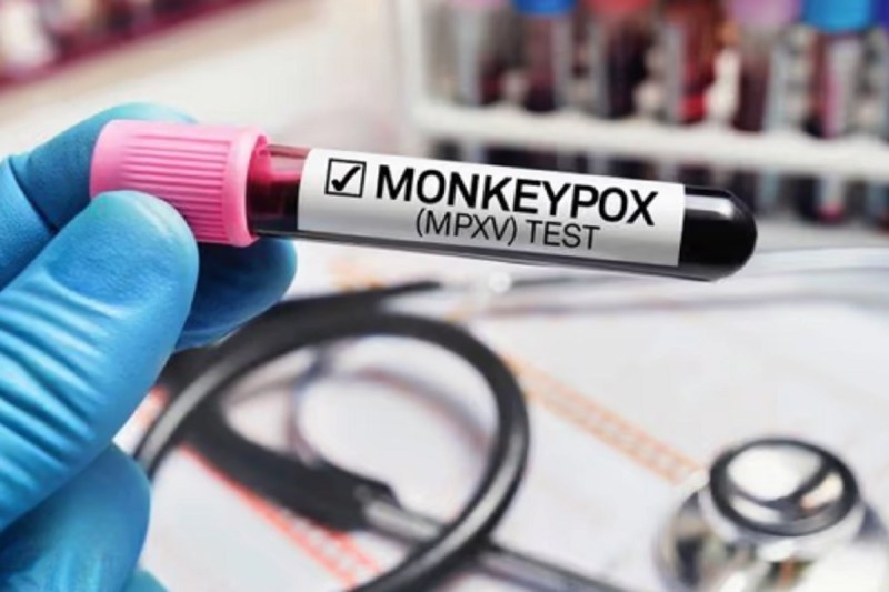 मंकीपॉक्स को लेकर यूपी में अलर्ट, स्वास्थ्य विभाग जारी करेगा गाइडलाइन