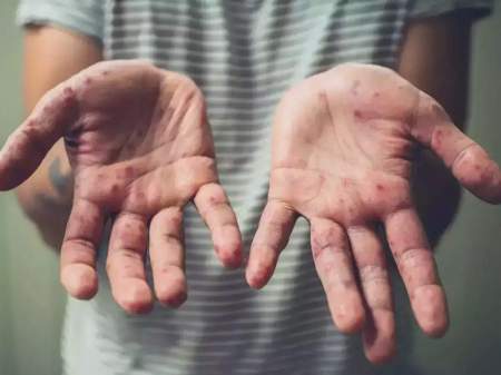 Monkeypox in India