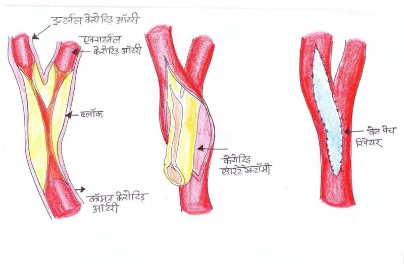 aiims jodhpur: बायपास सर्जरी के साथ दिमाग की खून की नस के 99 प्रतिशत ब्लॉकेज का ऑपरेशन