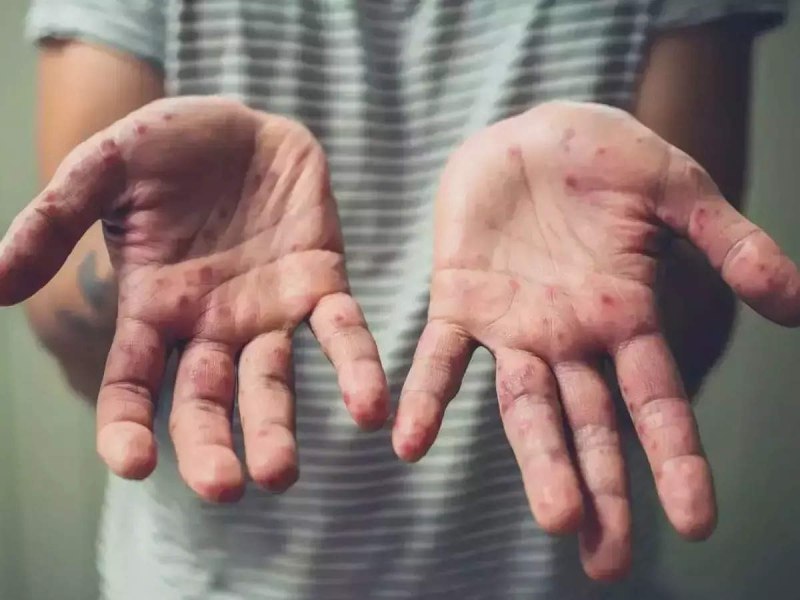  Symptoms like monkeypox seen in the woman medical team ran away sample was sent