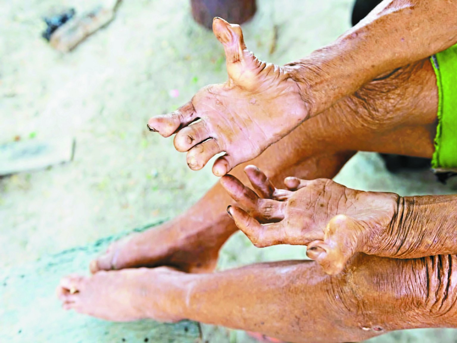 चार माह में स्वास्थ्य विभाग को मिले 247 कुष्ठ रोगी