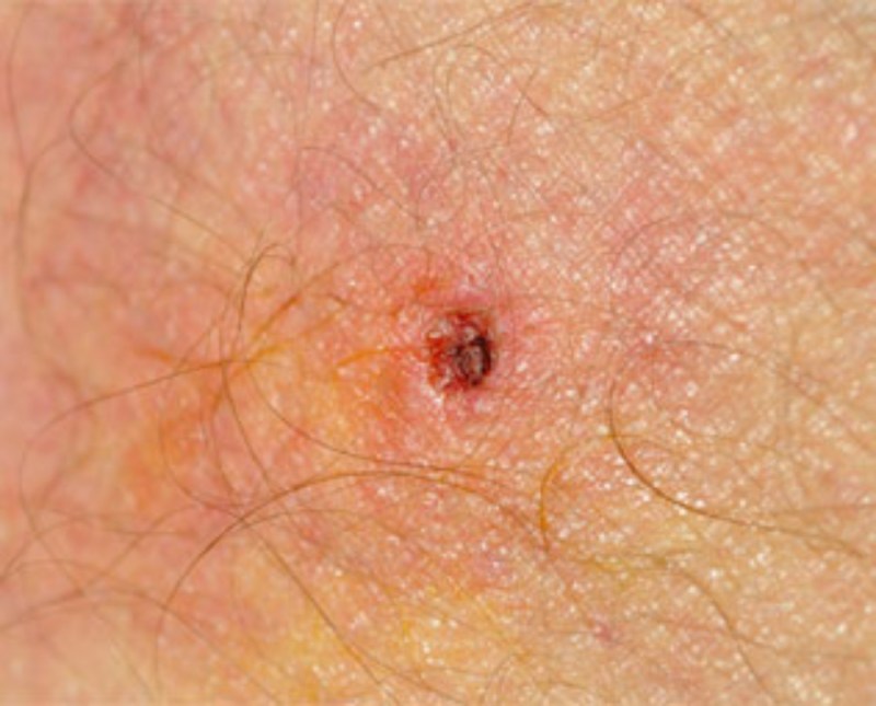 Scrub Typhus in Meerut: मेरठ में स्क्रब टाइफस की दस्तक, बच्चे की इलाज के दौरान गई जान