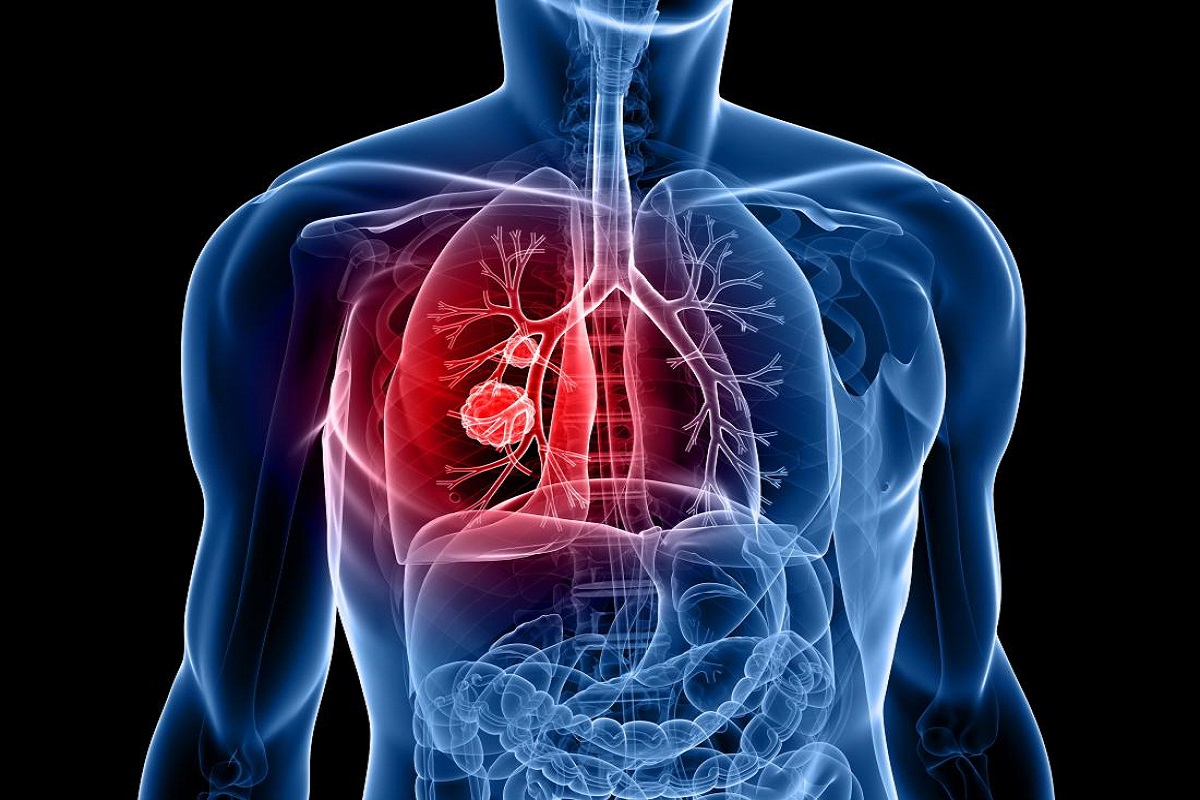 World Lung Cancer Day 2022: फेफड़ों के कैंसर से कोसों दूर रहने के लिए अपनी डाइट इन 4 चीजों को जरूर करें शामिल, रहेंगे हमेशा स्वस्थ