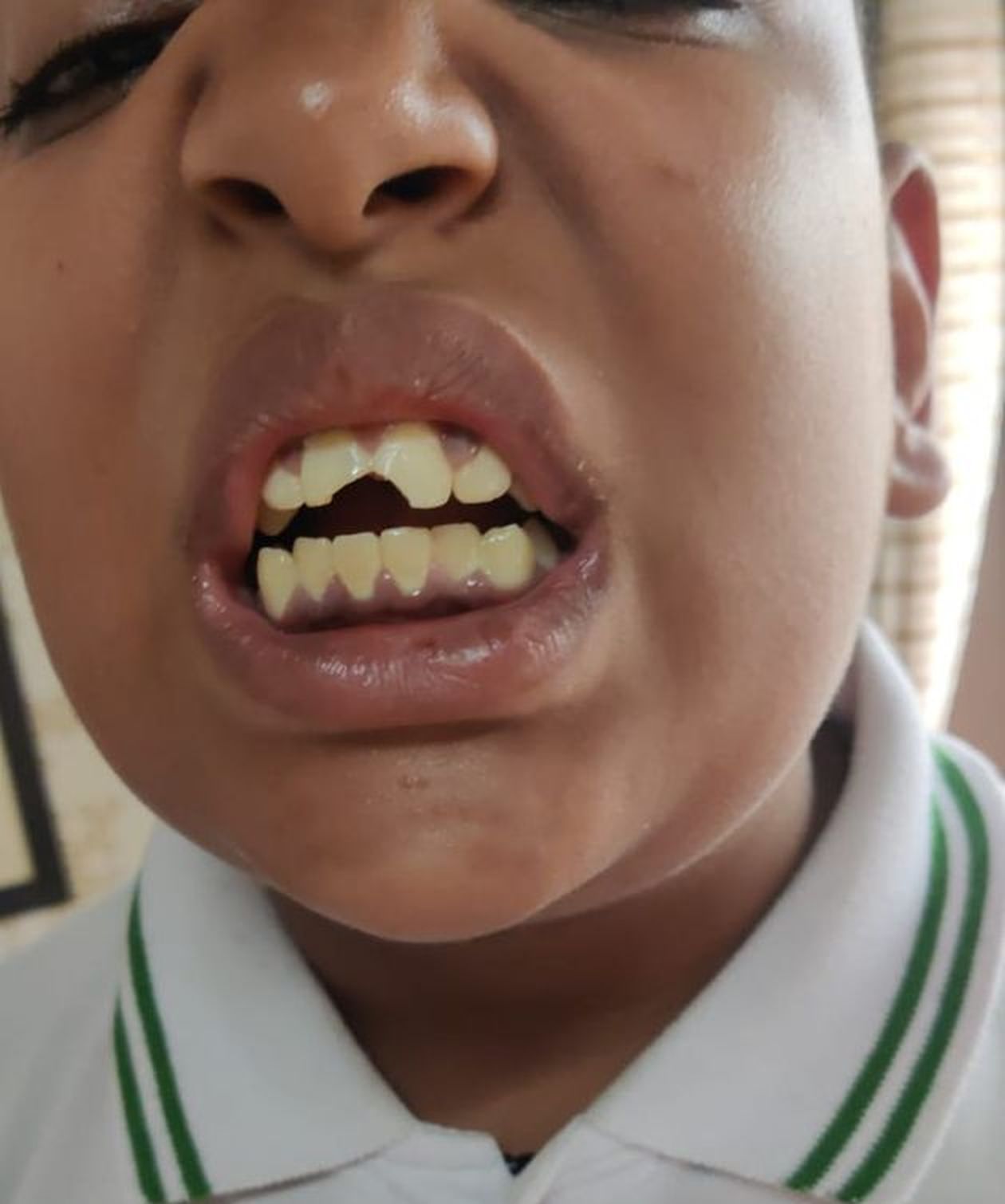 सवाल का जवाब पहले देने पर शिक्षक ने पीटा, बच्चे के दांत टूटे, केस दर्ज