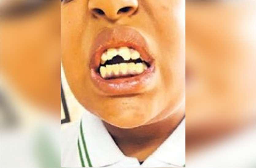 teacher beat student and baby teeth broken in udaipur