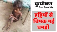 satna: कुपोषण ऐसा फैला कि बच्ची की हडि़्डयों से चिपक गई चमड़ी
