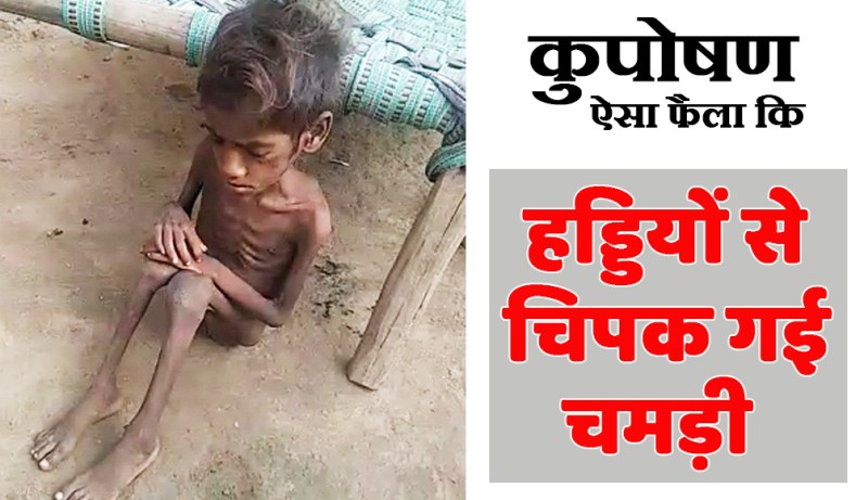 satna: कुपोषण ऐसा फैला कि बच्ची की हडि़्डयों से चिपक गई चमड़ी