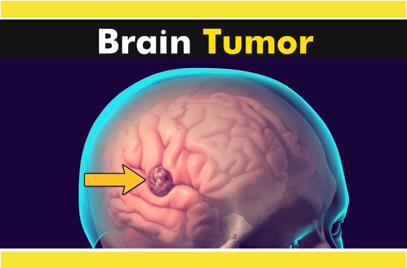 brain_tumor_symptoms.jpg