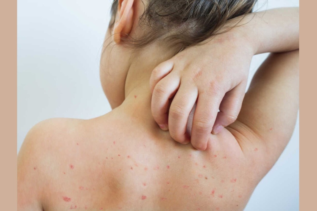 measles_outbreak.jpg