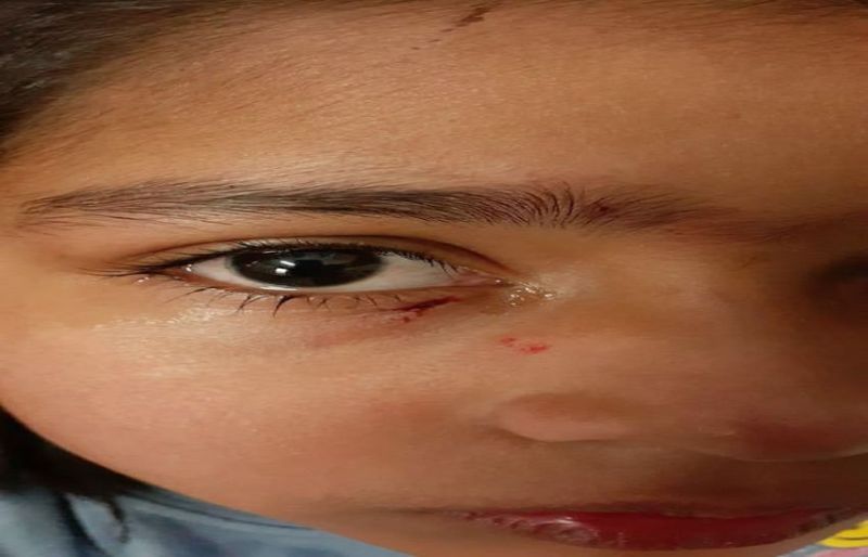 शहर में कुत्ते और बंदरों का आतंक एक ही दिन में 32 लोगों को काटा