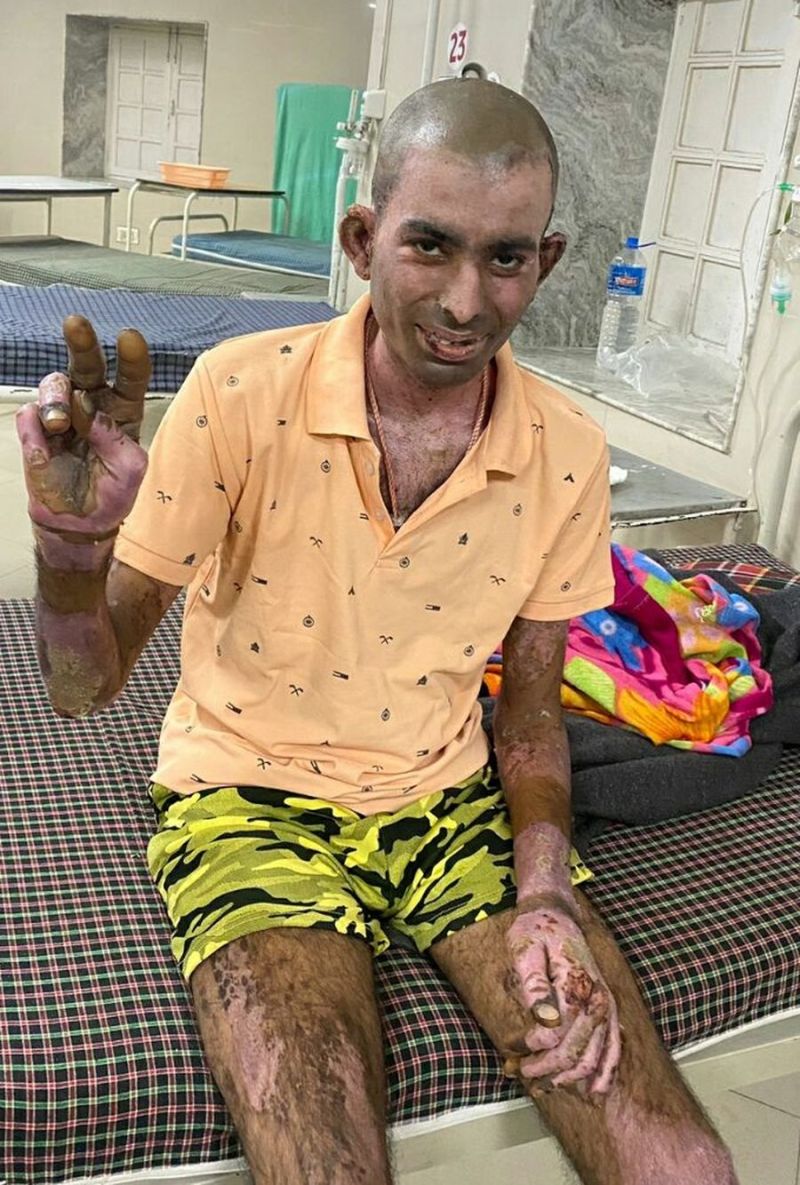 Gas tragedy : एक और युवक स्वस्थ्य, डिस्चार्ज कर घर भेजा