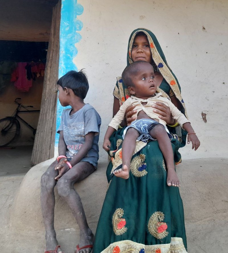 malnutrition in india