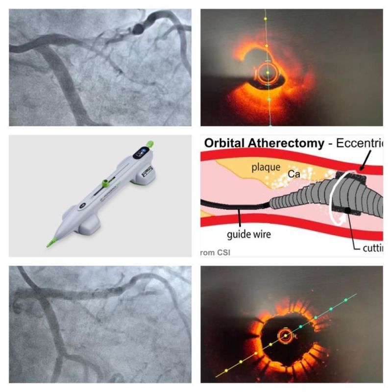 mdm hospital : हृदय की धमनियों में जमे कैल्शियम को काटने का नई तकनीक से प्रदेश में पहला ऑपरेशन