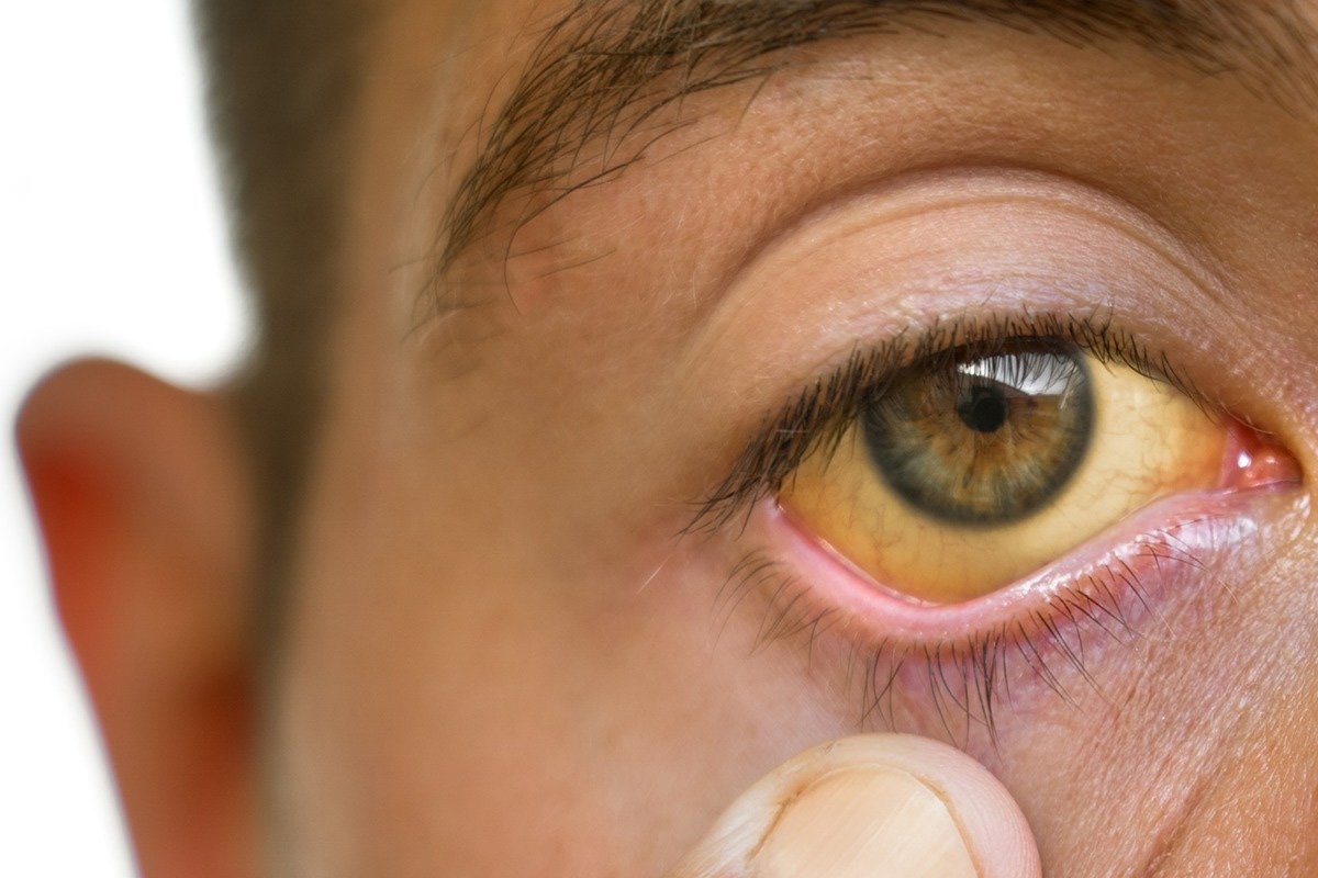 Symptoms of jaundice