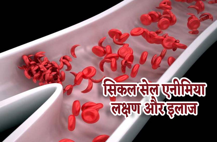 what_is_sickle_cell_anemia_and_symptoms_to_which_pm_modi_start_national_sickle_cell_anemia_eradication_campaign_from_shehdol_in_mp.jpg
