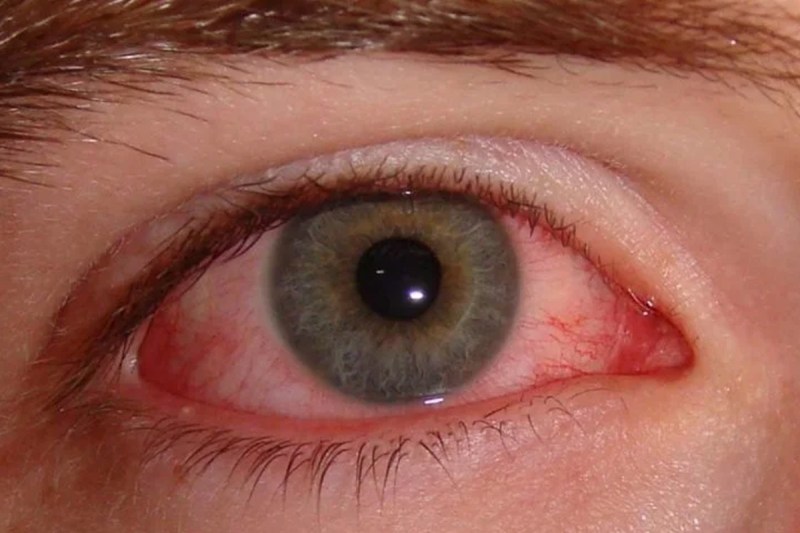 eye-flu-symptoms.jpg