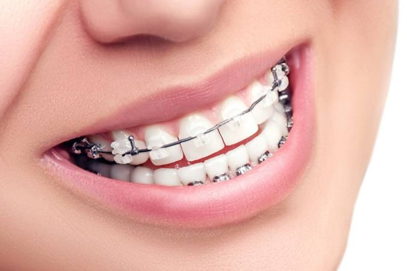teeth-braces.jpg