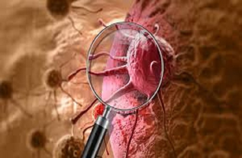 देश में 2000 से 2019 के बीच कैंसर से पुरुषों की तुलना में महिलाओं की मौतें ज्यादा, कुल केस बढ़े