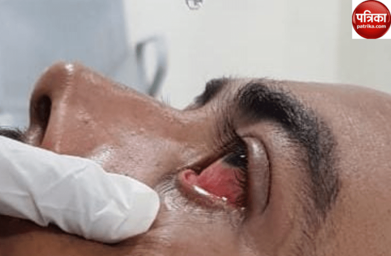 Chitrakoot News : आई फ्लू से घबराएं नही,जाने इस बीमारी के लक्षण और बचाव के उपाय