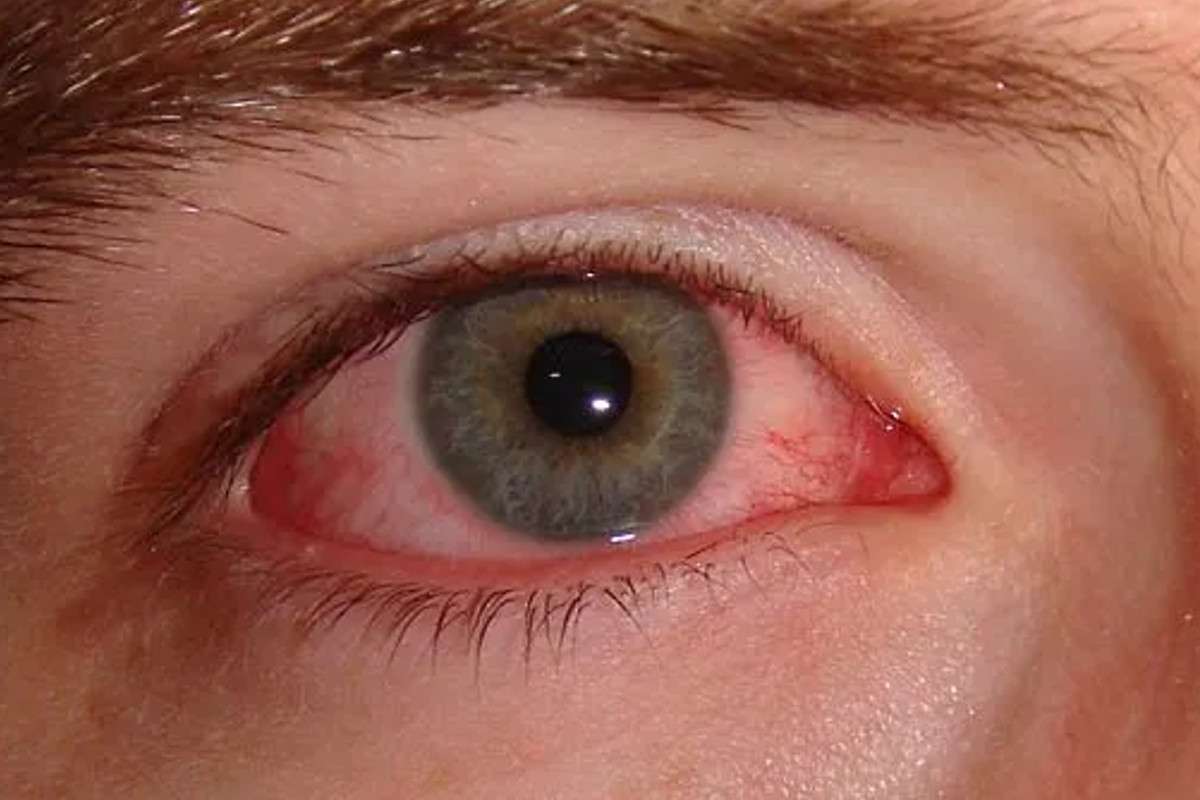 eye_flu.jpg