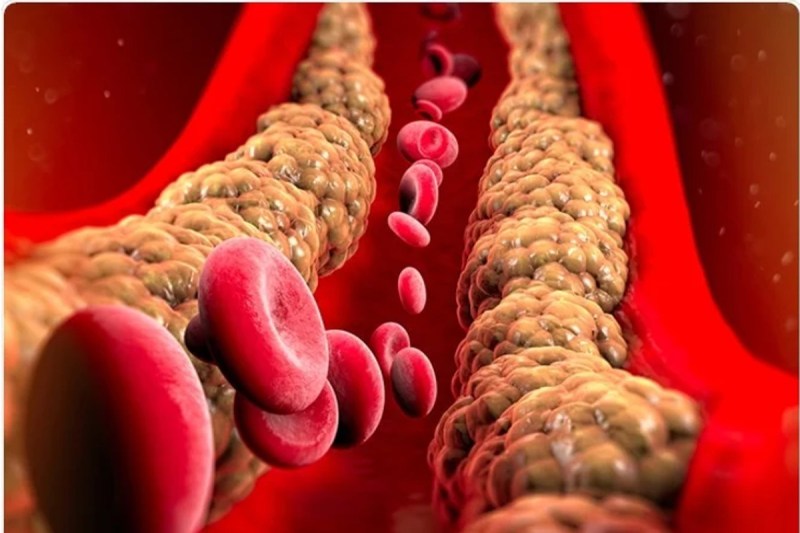 High triglycerides can increase the risk of heart attack or stroke