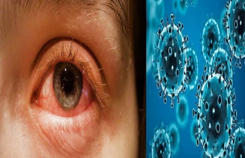 संक्रमित की आंखों में देखने से नहीं, संपर्क में आने से फैलता है ‘पिंक आई’