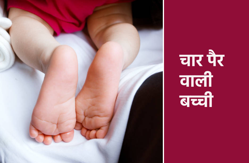 मध्यप्रदेश में चार पैर वाली बच्ची का जन्म, पहले भी आए ऐसे अनोखे मामले