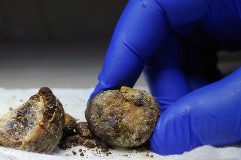 Home Remedies for Gall bladder Stone