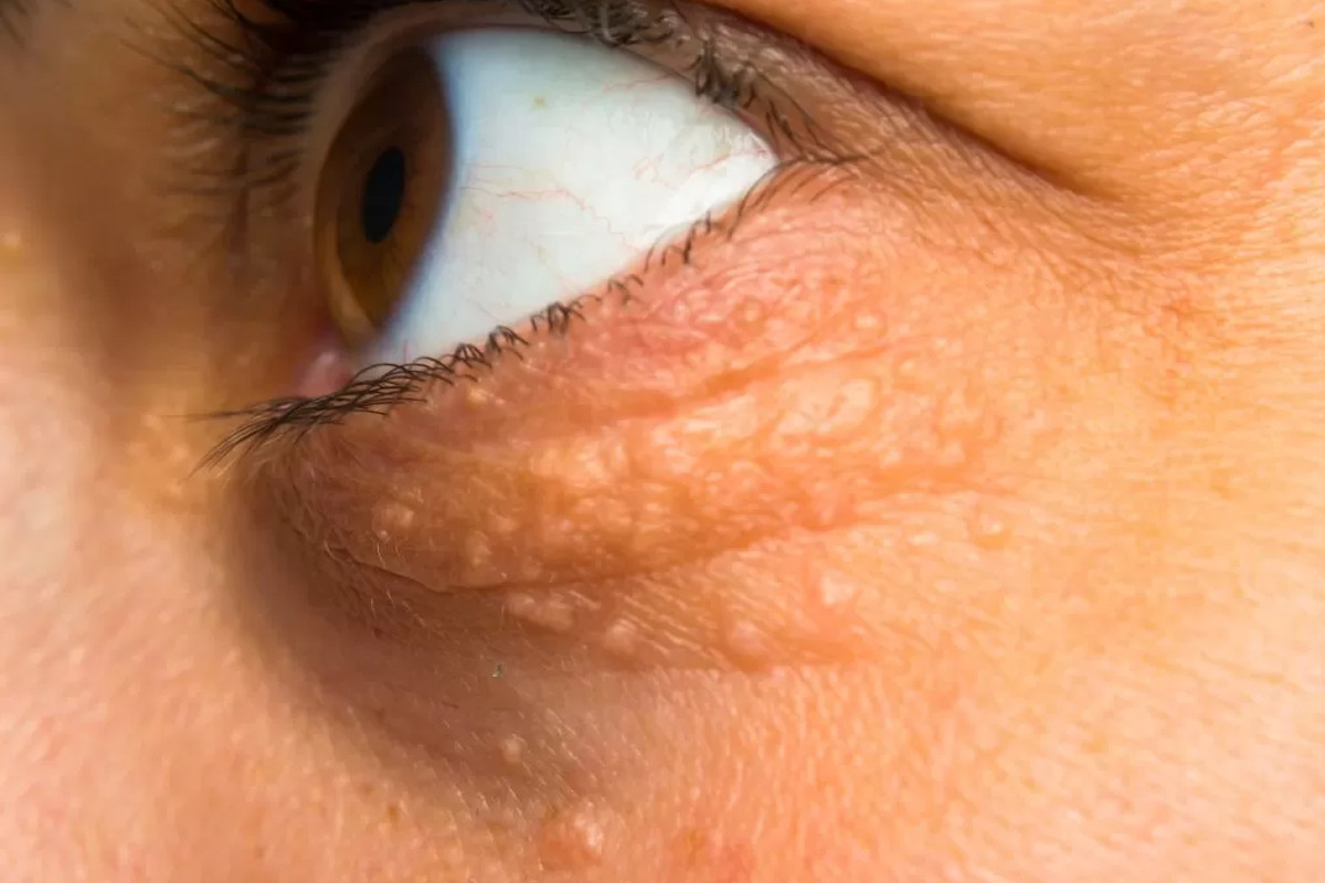 Symptoms of cholesterol in the eyes