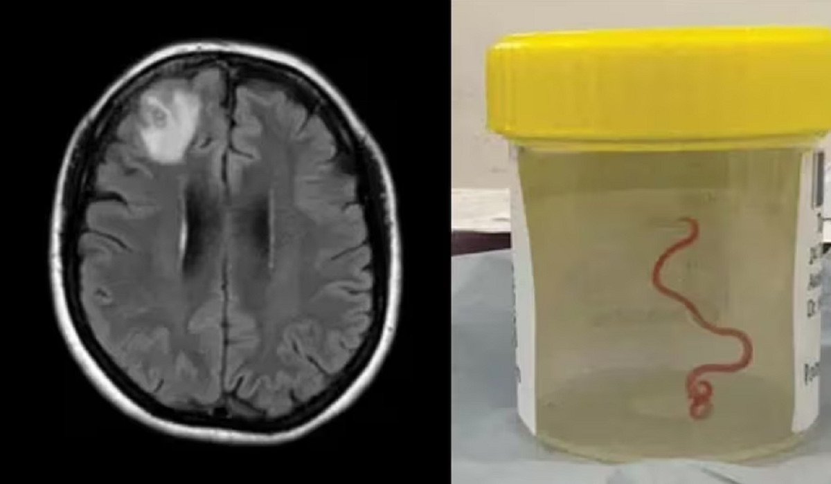 live_worm_found_in_brain_of_woman_for_the_first_time_in_australia.png