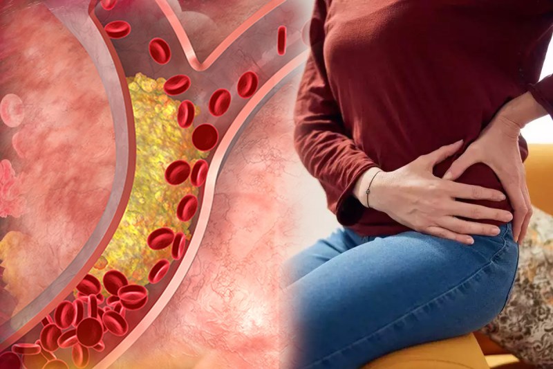 Change in hip shape can be a symptom of high cholesterol