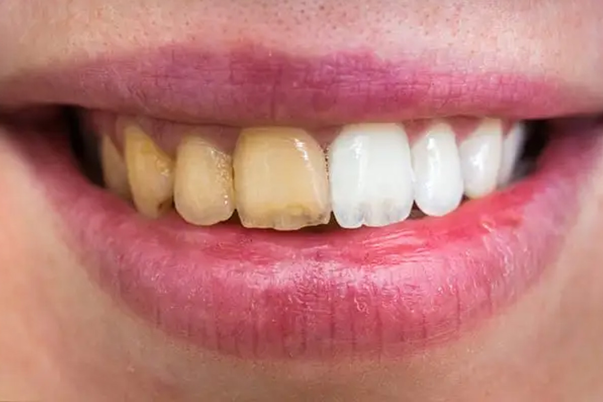 neem se danto ko safed kaise kare