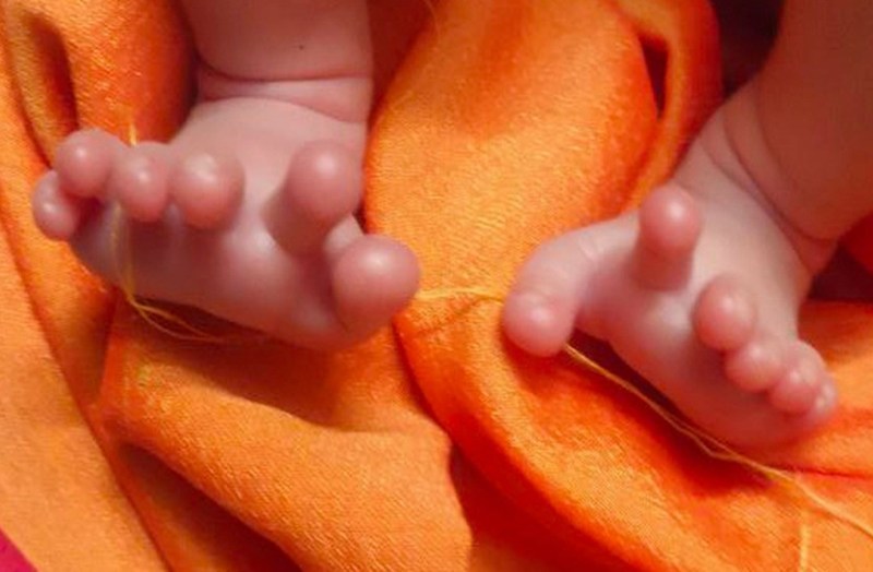 A Girl With 26 Fingers Was Born in Bharatpur