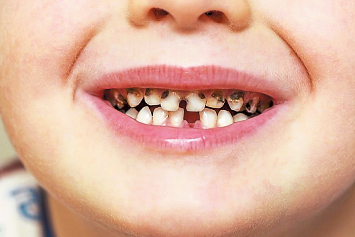 Oral Hygiene: After eating sweets do not forget to rinse your mouth