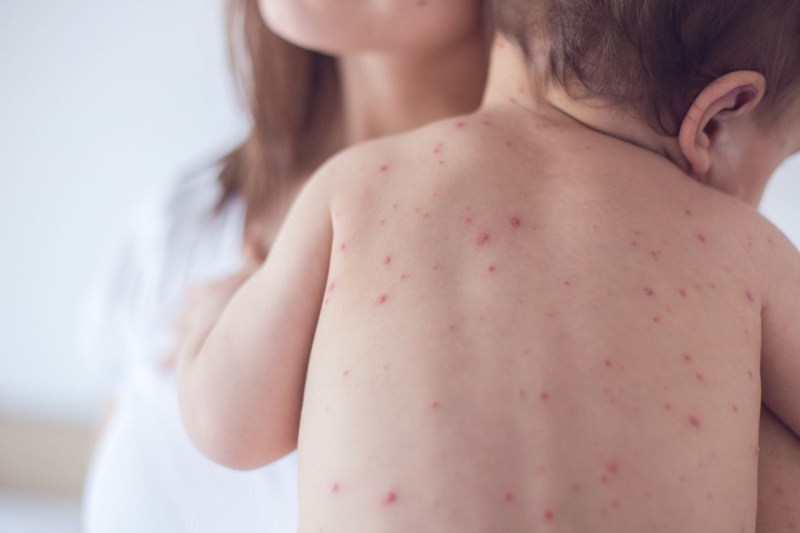 measles.jpg