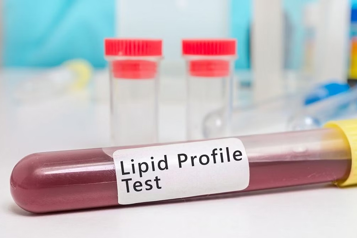 lipid-profile-test.jpg