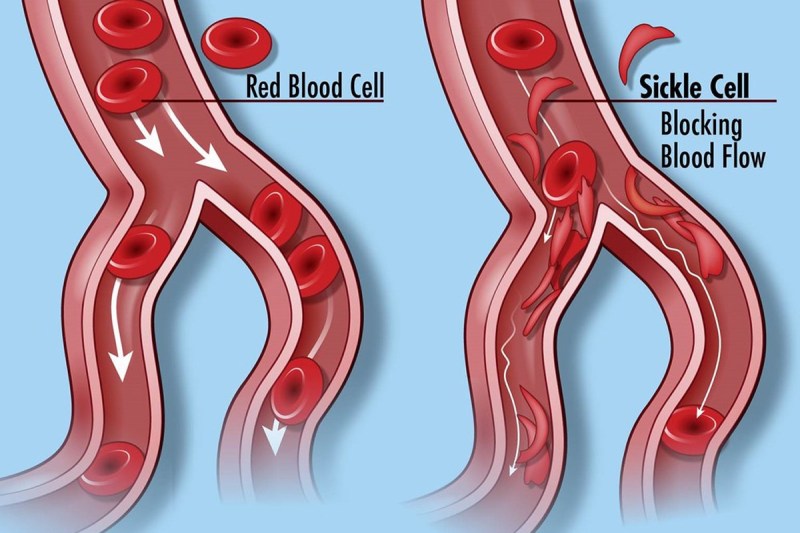 Sickle cell anemia