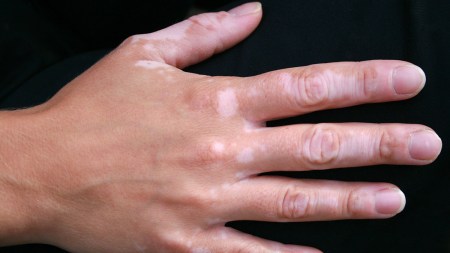 vitiligo.jpg