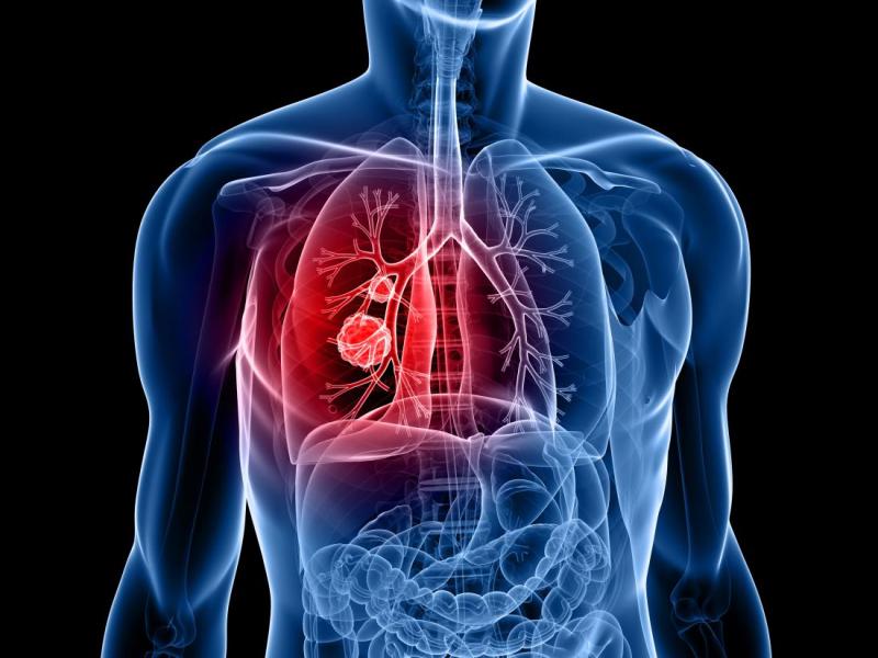 Lung Cancer Awareness: देश में तेजी से बढ़ रहे हैं लंग कैंसर के मामले, स्टेज 3 और 4 में चल रहा है पता, साधारण दिखने वाले लक्षणों को न करें इग्नोर