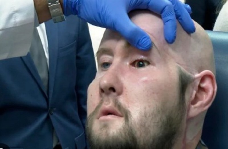 अमरीकी डॉक्टरों ने किया दुनिया का पहला संपूर्ण नेत्र प्रत्यारोपण