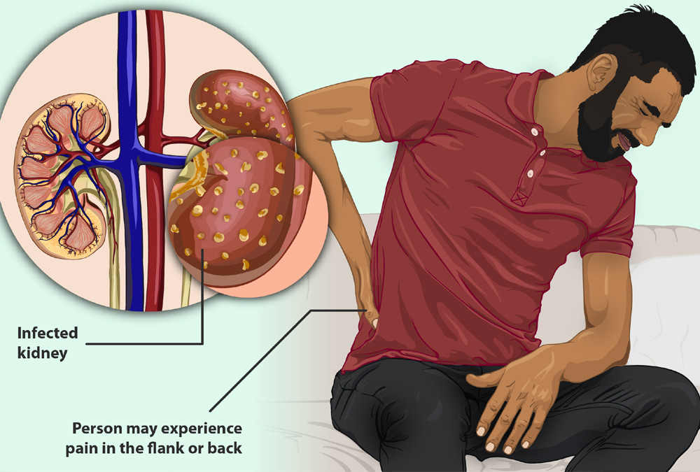 kidney-infection.jpg