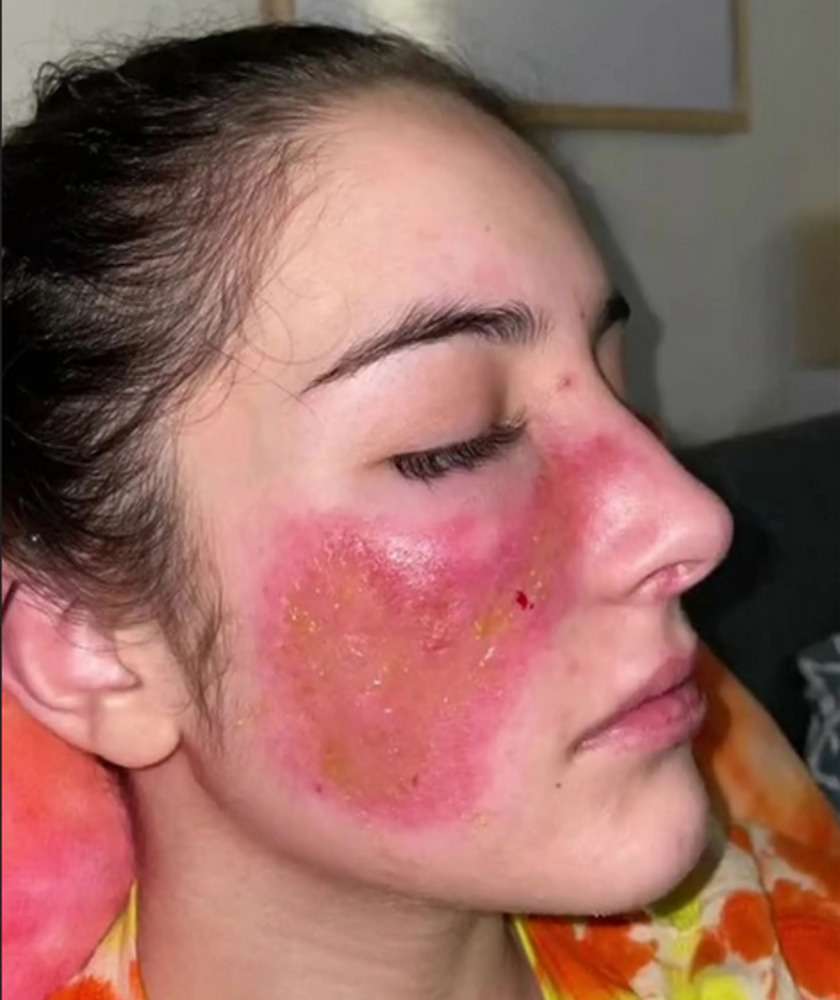 beth_tsangarides_skin_burn_1.jpg