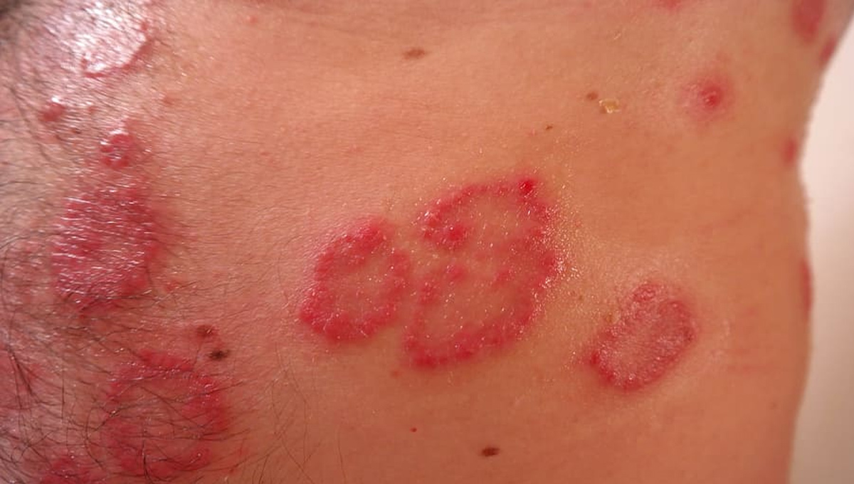 psoriasis.jpg
