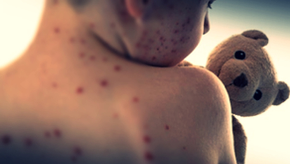 measles.jpg