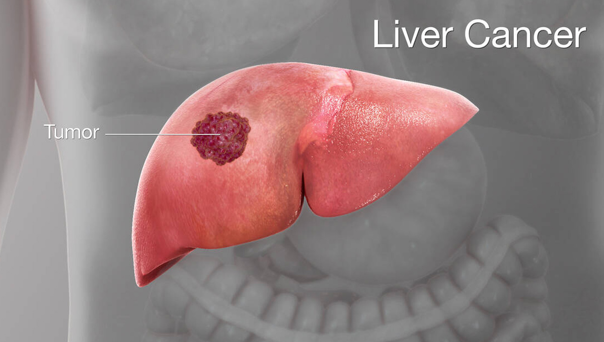 liver-cancer.jpg