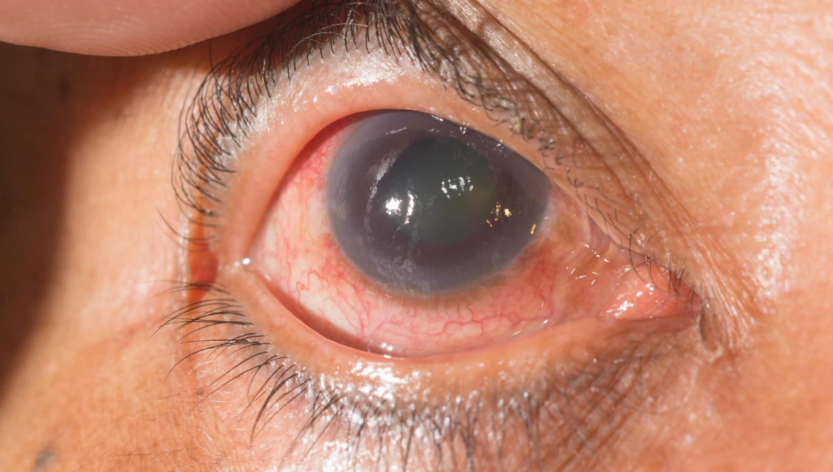 glaucoma.jpg