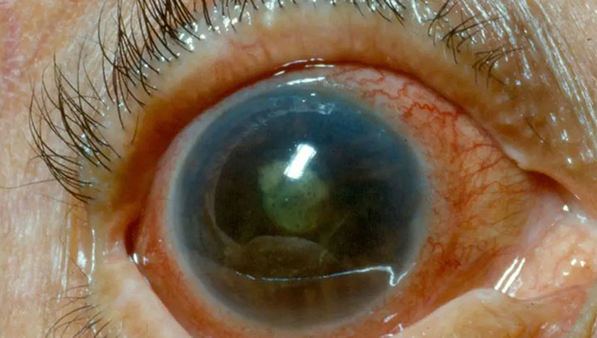 glaucoma.jpg