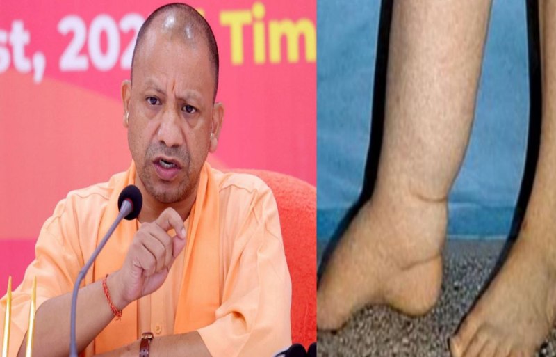 5 से 15 साल में दिखाई देते हैं फाइलेरिया के लक्षण