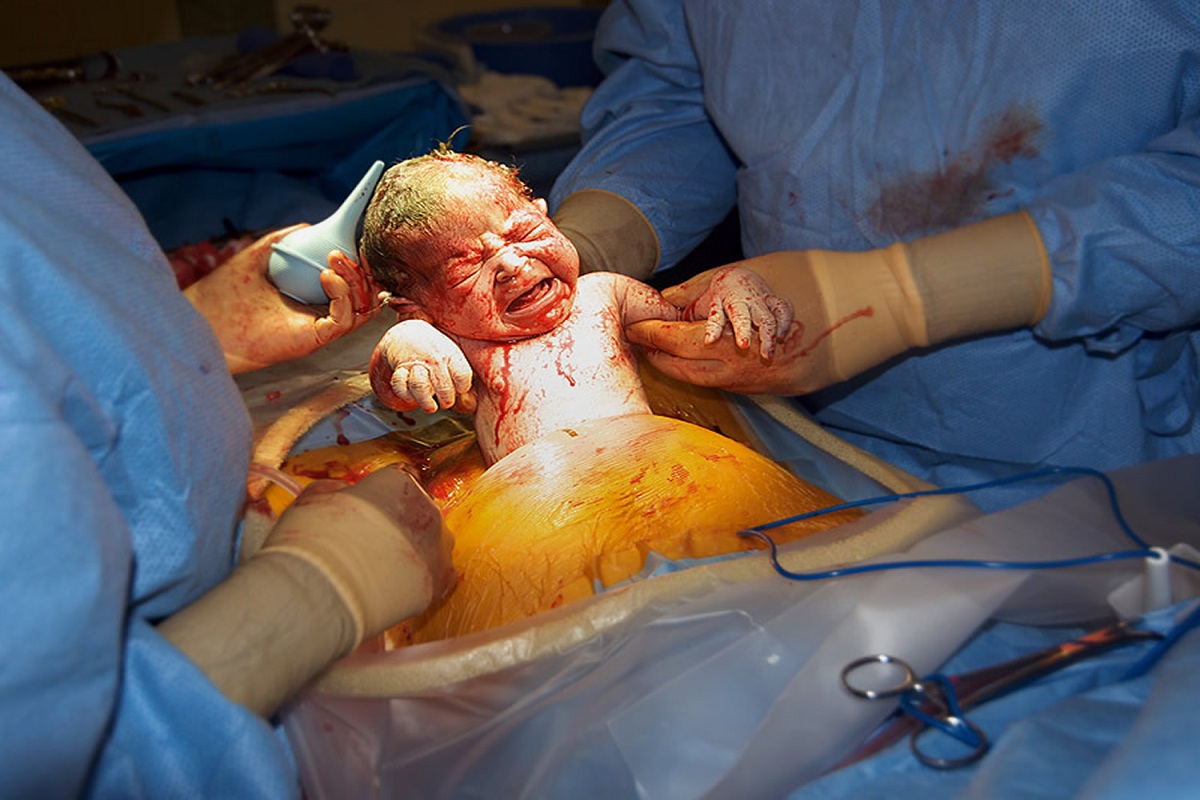 cesarean-section.jpg